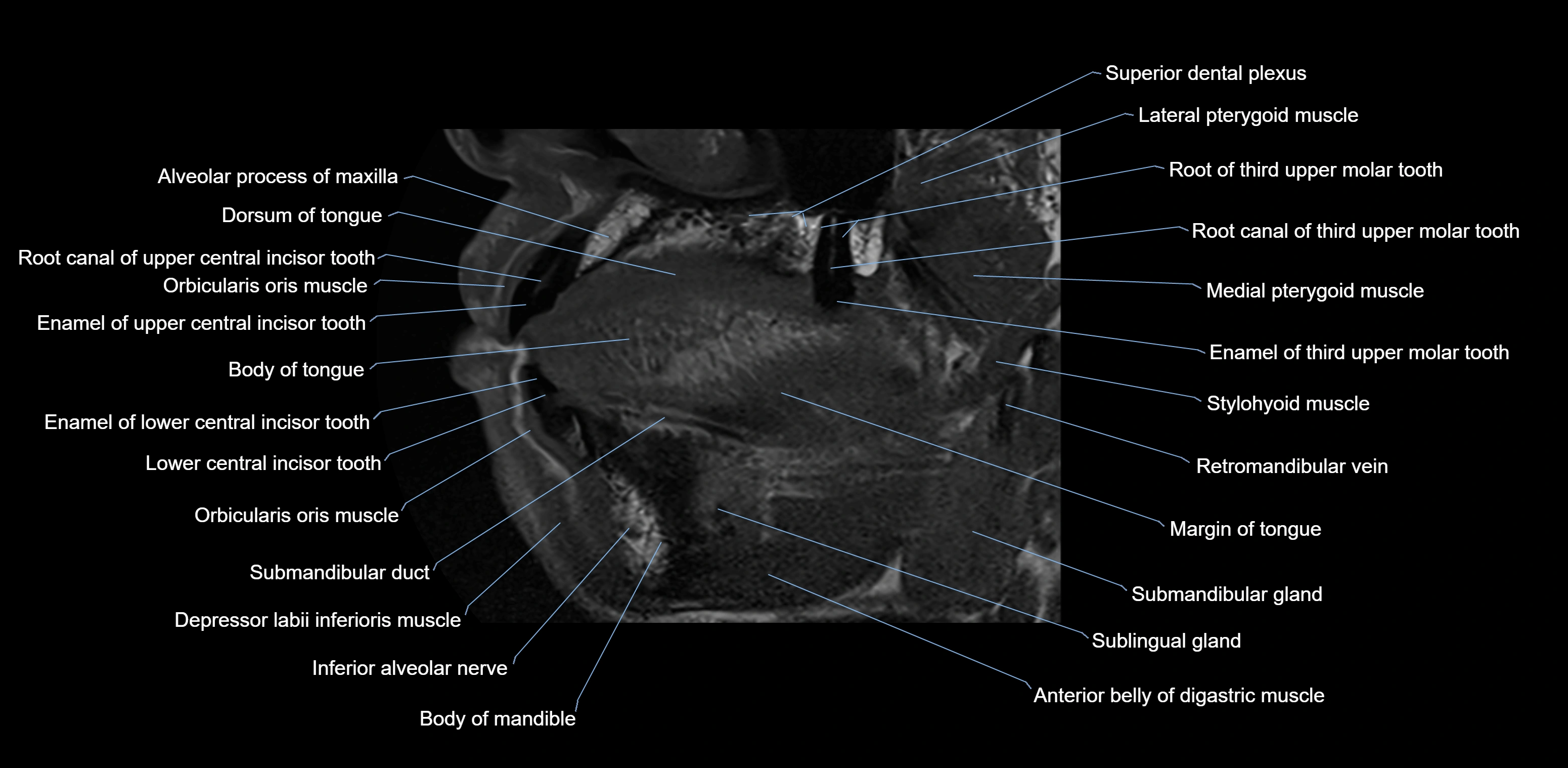 Dental MRI( tooth) sagittal labelled  cross sectional 3T anatomy -img-00001-00011.webp